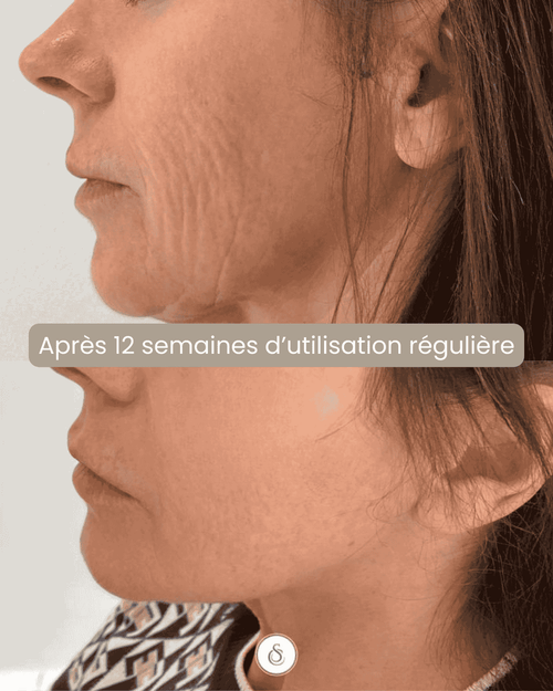 Radiofréquence Visage – Fermeté & effet lift à domicile