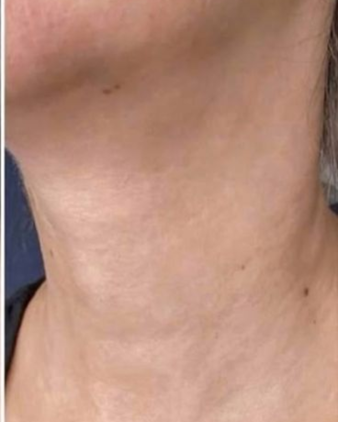 image apres cou decollete masque led 