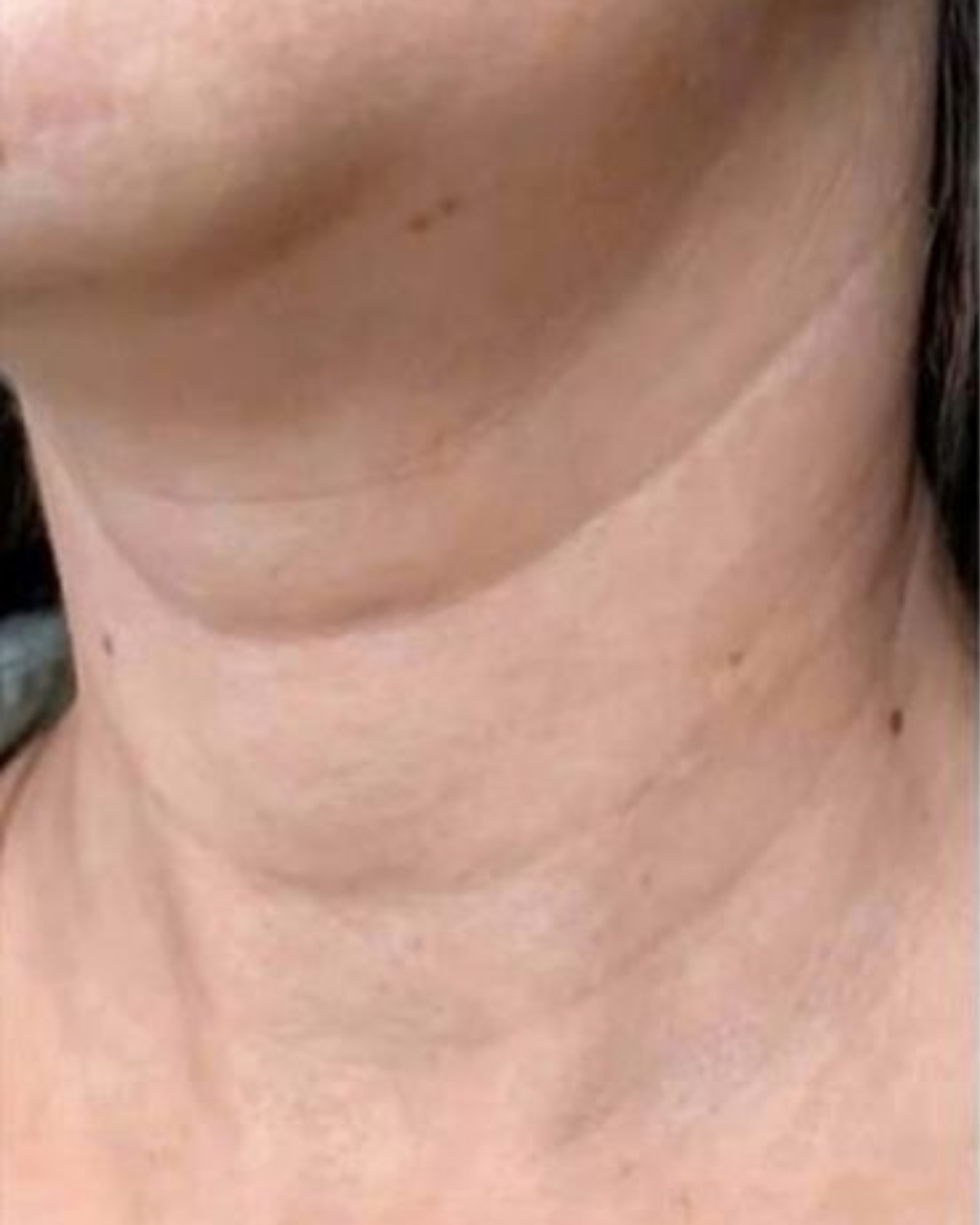 image avant cou decollete masque led 