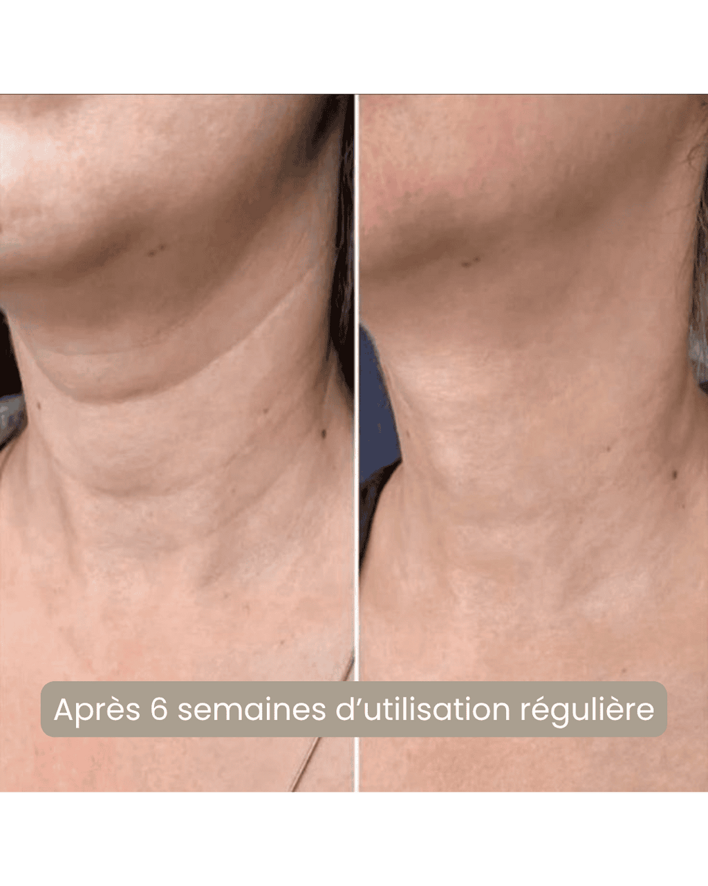 Avant après masque LED cou Nova Rituals - résultat peau fermeté décolleté