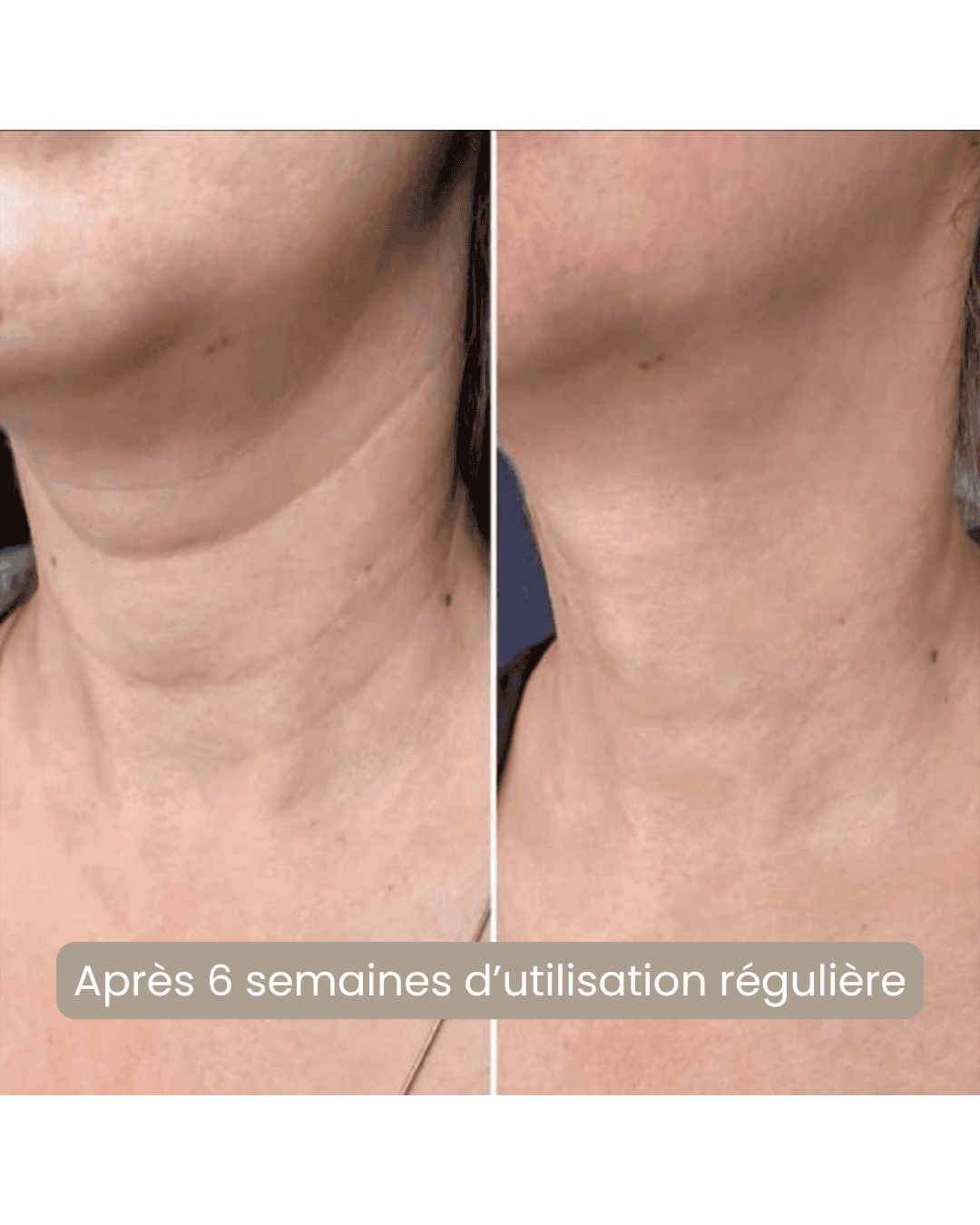 Avant après masque LED cou Nova Rituals - résultat peau fermeté décolleté