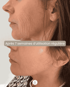Radiofréquence Visage – Fermeté & effet lift à domicile