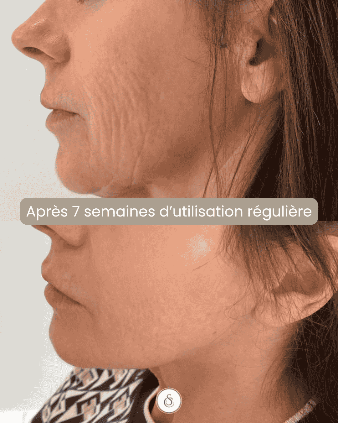 Radiofréquence Visage – Fermeté & effet lift à domicile